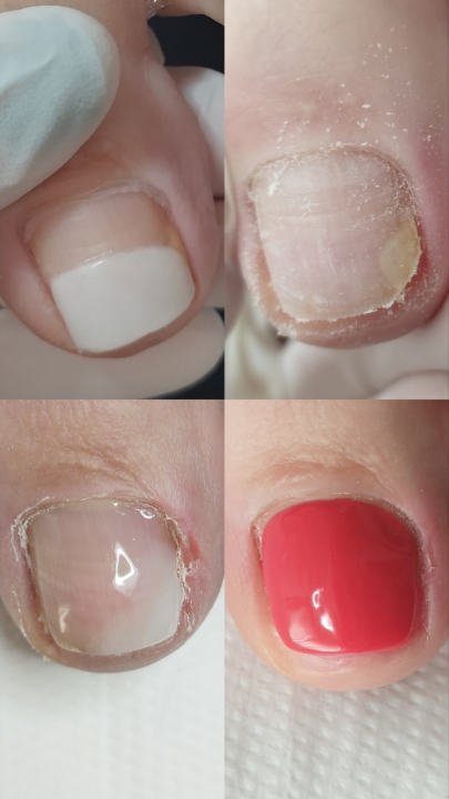 Riješite se uraslih noktiju uz medicinsku pedikuru!