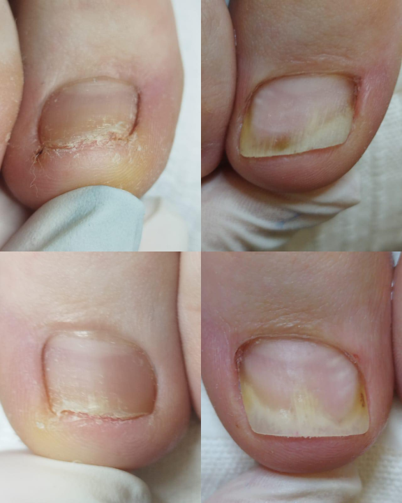 Pružite svojim stopalima maksimalnu njegu i riješite tegobe uz medicinsku pedikuru!