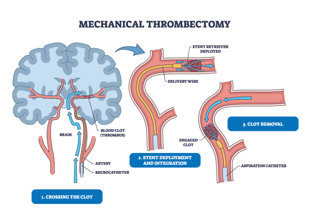 FOTO Dr. Ivan Miletić iz Poliklinike Pupillam: Moždani udar, kako što ranije otkriti aterosklerozu kao uzrok