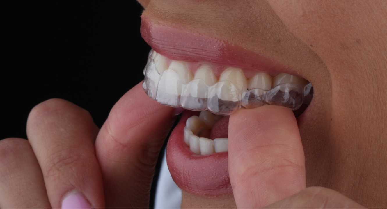 FOTO Osmijeh iz snova uz prozirne alignere Dental centra Dubravica! 	