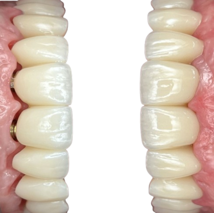 FOTO Novi osmijeh uz Dental centar Dubravica: Što trebate znati prije ugradnje implantata