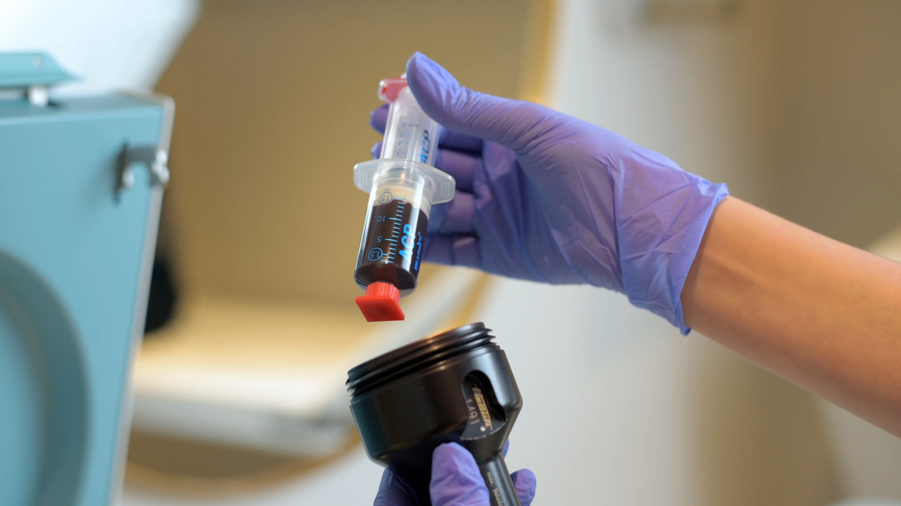 FOTO Sve traženiji PRP tretman sada i u Šibeniku: Evo o čemu je riječ!