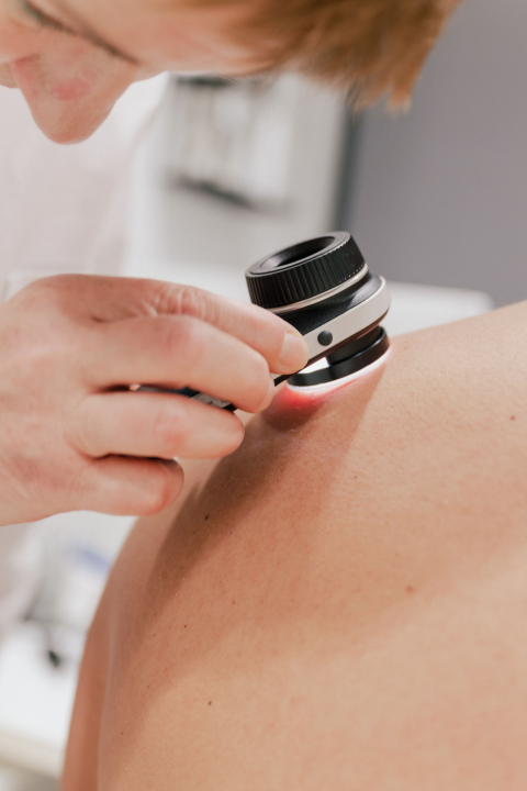 Dermatologinje upozoravaju: Prije ljeta obavezno pregledajte madeže