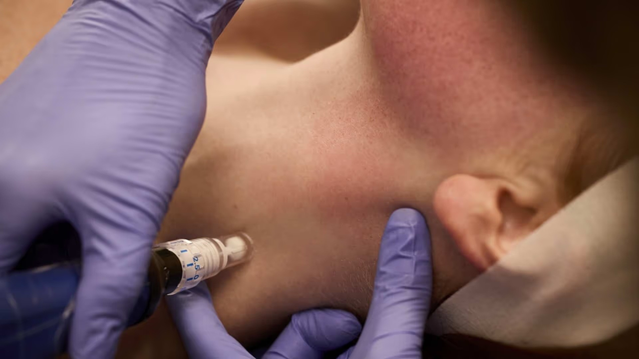Vrijeme je za čvršću, obnovljenu i blistaviju kožu uz SkinPen i radiofrekvenciju