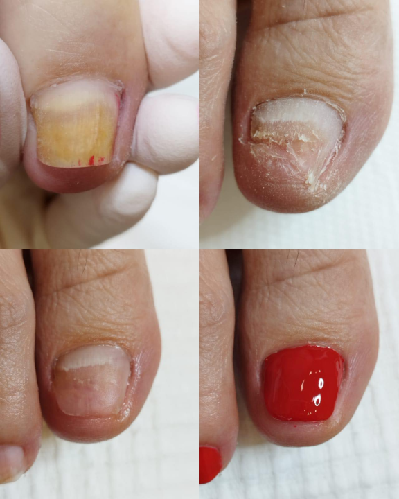 Pružite svojim stopalima maksimalnu njegu i riješite tegobe uz medicinsku pedikuru!