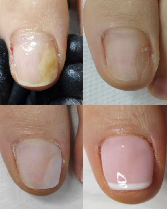 Riješite se uraslih noktiju uz medicinsku pedikuru!